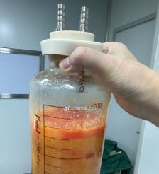 台湾水动力吸脂手术要做多久？